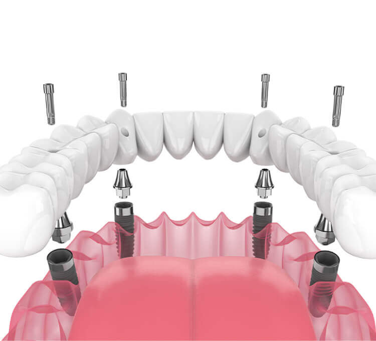 All-on-4 Same Day Teeth - Smile HQ