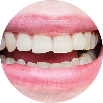 Composite Bonding Brentwood, Essex - Smile HQ