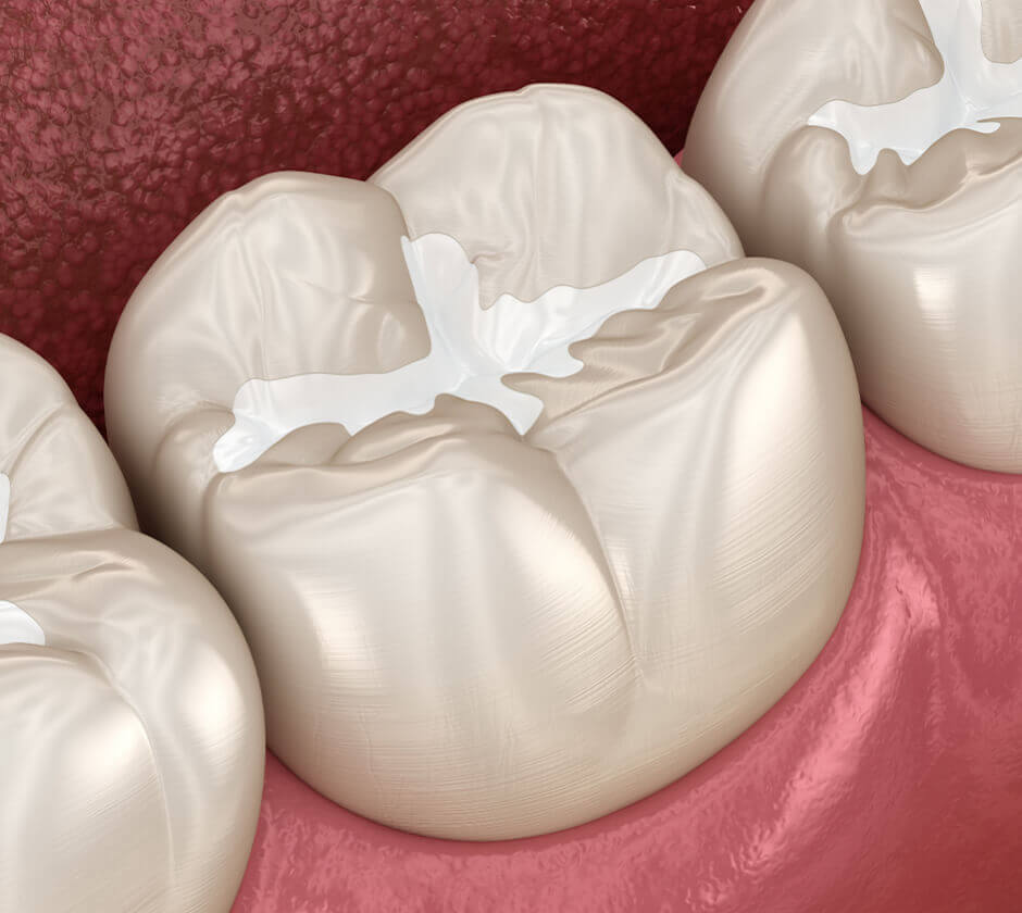 Dental Fillings Brentwood, Essex - Smile HQ
