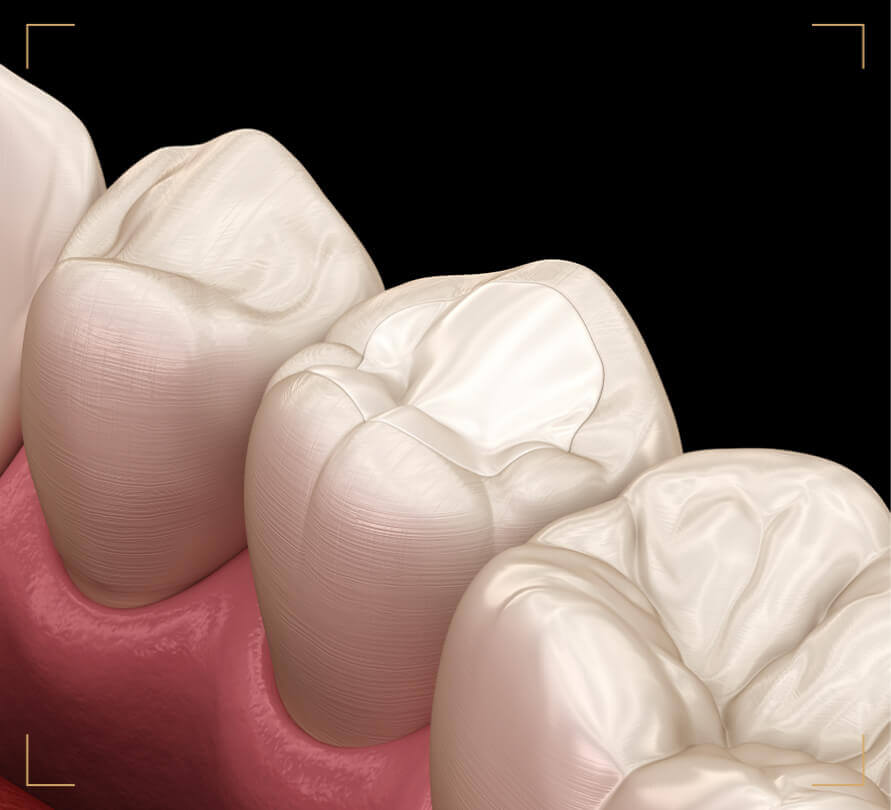 Dental Fillings Brentwood, Essex - Smile HQ