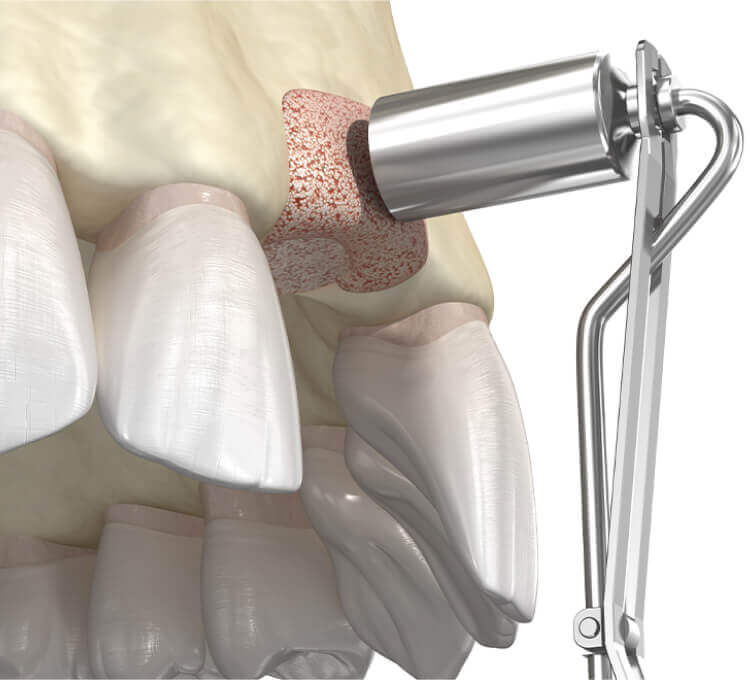 Bone and Sinus Grafts Brentwood, Essex