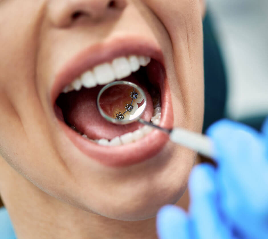 Lingual Braces Brentwood, Essex - Smile HQ