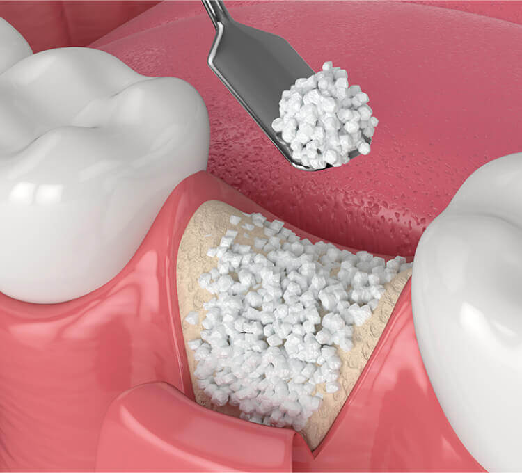Bone and Sinus Grafts Brentwood, Essex