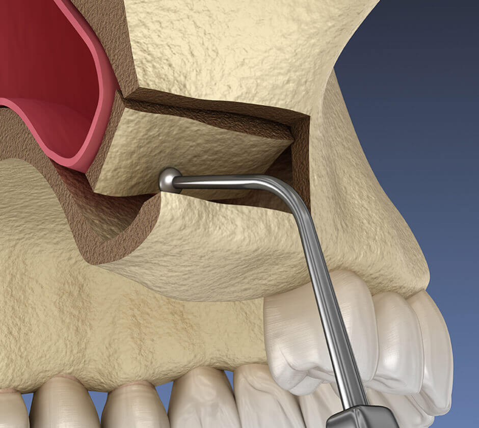 Bone and Sinus Grafts Brentwood, Essex