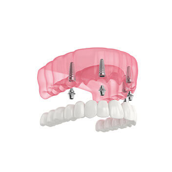 Dentures Brentwood, Essex - Smile HQ