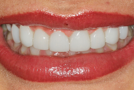 Close-up of a smile showing teeth after dental bonding treatment, with improved alignment and appearance.