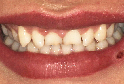 Close-up of a smile showcasing slightly uneven upper teeth with visible gaps.