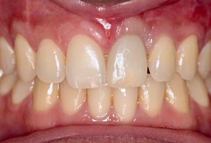 Close-up of a smile showing clean, aligned teeth after dental treatment.