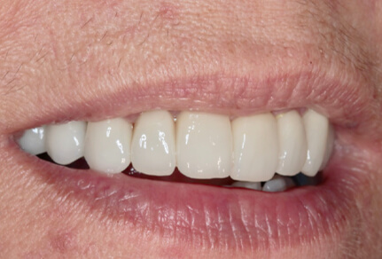 Close-up of a person's smile after dental bonding, showcasing smooth and evenly aligned white teeth with no visible gaps.