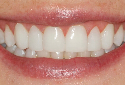 Dental bonding used to improve smile aesthetics.