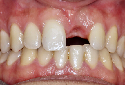 Close-up of a smile showing a missing tooth and uneven teeth before dental implant treatment.