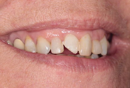 A close-up of a person's smile showing several teeth with visible damage, including chips or fractures, particularly on the upper left teeth.