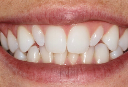 Close-up of a smile showing uneven teeth and gaps before dental bonding treatment.