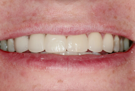 A close-up image of a person's smile showing a set of healthy, white teeth after dental treatment.