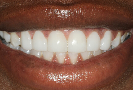 Close-up of a smile showing straightened teeth after Invisalign treatment.