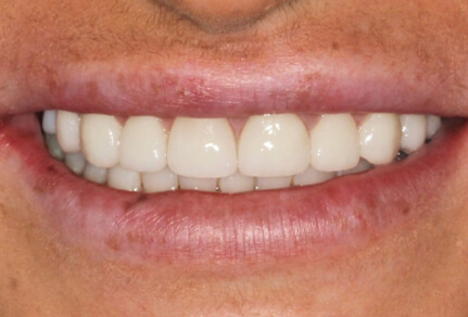Close-up of a smile showing even, bright teeth after dental treatment.