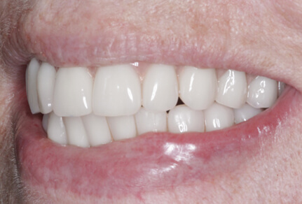 Side view of a smile showcasing dental implants with even, bright teeth.