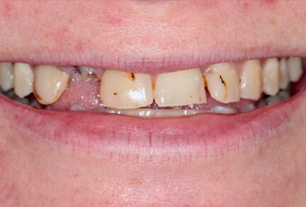 A close-up of a patient's smile showing damaged, misaligned teeth before implants.