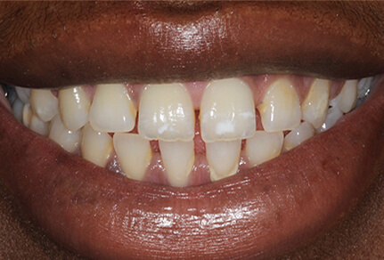 Close-up of a smile showing uneven teeth and gaps before Invisalign treatment.