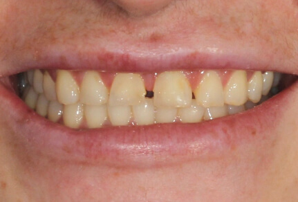 Close-up of a smile showing uneven teeth and visible gaps before dental treatment.