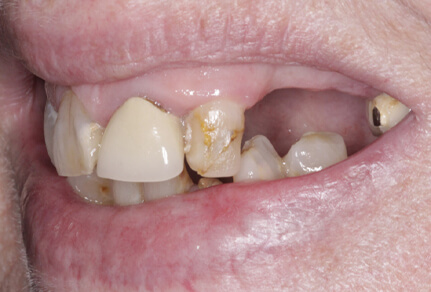 A close-up image showing a patient's smile with missing teeth, indicating the need for implants.