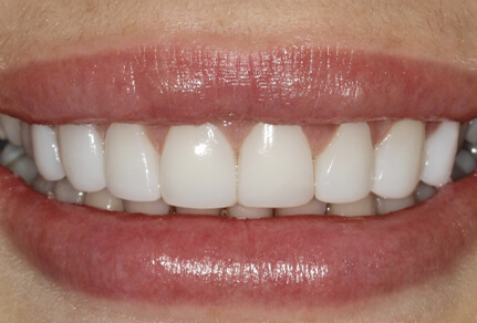 Close-up of a smile showing enhanced, evenly aligned teeth through dental bonding.