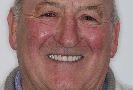 A close-up of an elderly man smiling after dental implant treatment, showing a bright and natural-looking set of teeth.