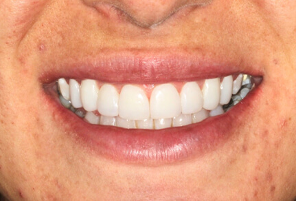 The image shows a person with a beautiful smile, likely after Invisalign treatment.