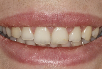 Close-up of a smile showing uneven teeth with visible gaps, likely before dental bonding treatment.