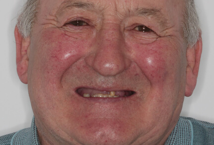 Close-up of a patient’s smile showing uneven and missing teeth before dental implants.