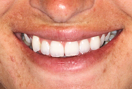 A close-up of a patient's smile showing straight, white teeth after cosmetic dental treatment.