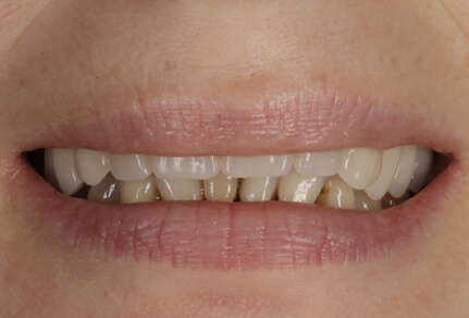 Close-up of a smile showing uneven teeth with visible gaps, potentially before dental treatment.