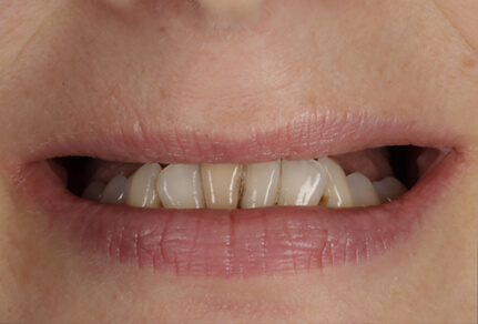 Close-up of a woman's smile showing dental bonding on her upper teeth with noticeable unevenness in the edges.