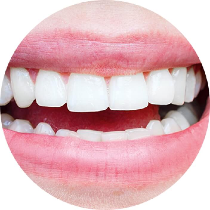 Composite Bonding Brentwood, Essex - Smile HQ