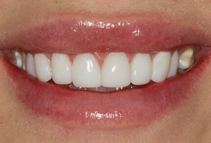 Close-up of a smile showing teeth enhanced with dental bonding for a more uniform appearance.