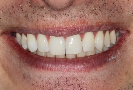 A patient's smile showing a set of straight, white teeth after dental treatment.