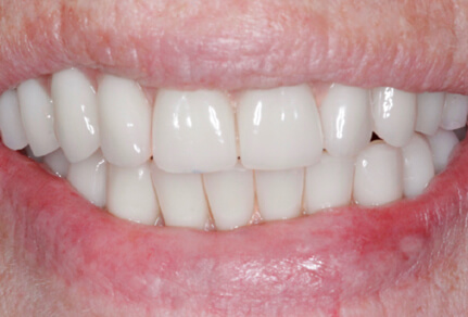 Close-up of a smile showing dental implants with even, bright teeth after treatment.