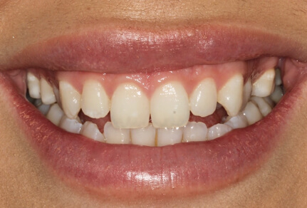 ChatGPT said: Close-up of a smile showing teeth with visible gaps, before dental bonding treatment.