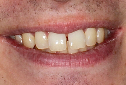 It looks like the image shows teeth before a cosmetic dental treatment such as veneers or bonding.