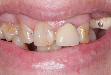 Close-up of a smile showing worn, discolored, and missing teeth before dental treatment.