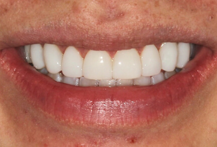 Close-up of a smile showing even, bright teeth after dental treatment, with improved alignment and appearance.