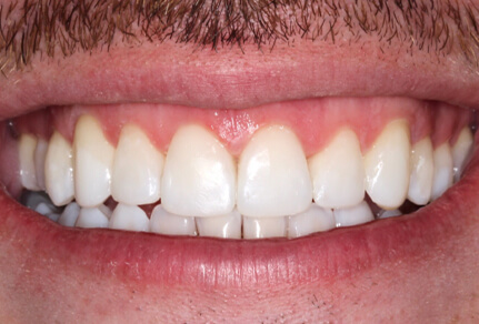 Close-up of a smile showing teeth after Invisalign treatment, with improved alignment.