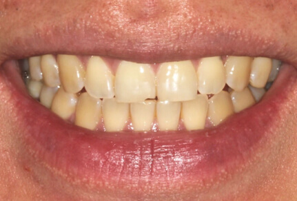 SmileHQ cosmetic dental treatment results, Brentwood, Essex