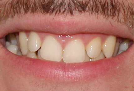 Close-up of a smile showing uneven teeth with noticeable gaps before Invisalign treatment.