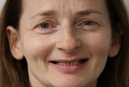 Close-up of a patient’s smile showing missing and uneven teeth, likely before receiving dental implants.