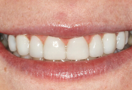 Close-up of a smile showing even, white teeth after dental bonding.