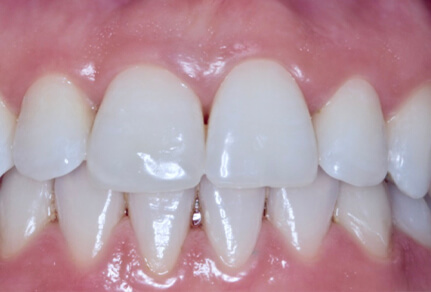 Patient smile transformation at SmileHQ, Brentwood, Essex
