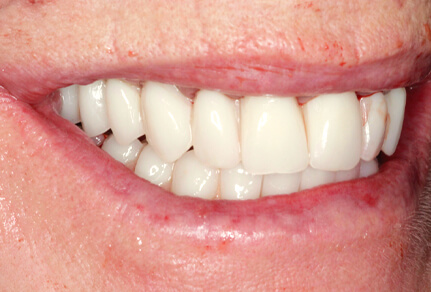 Teeth straightening results at SmileHQ, Essex