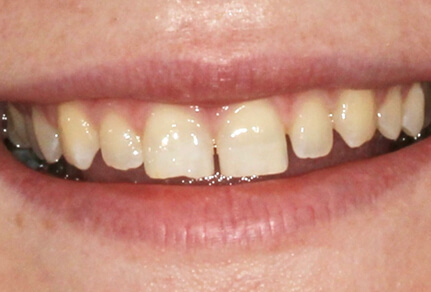 Close-up of a patient's teeth before bonding, showing visible gaps between the front teeth.