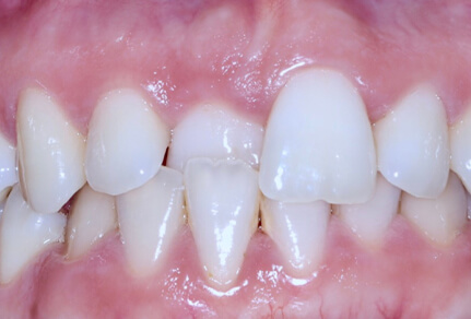 Close-up of a smile showing uneven teeth and gaps before Invisalign treatment.